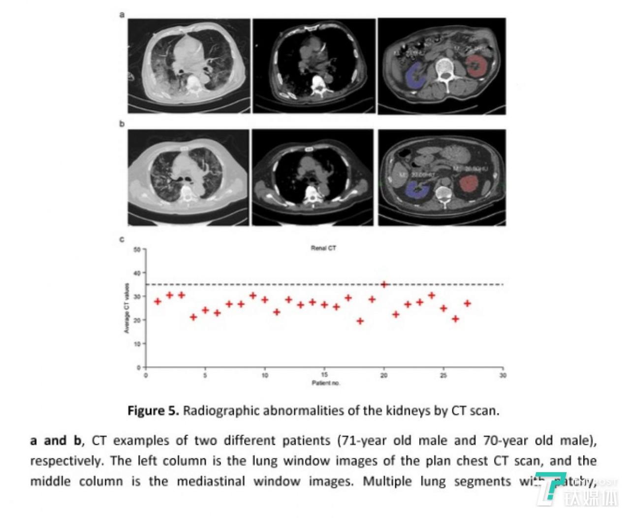 CT 扫描显示的肾脏放射影像异常情况