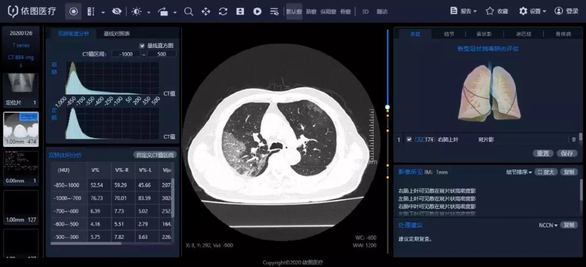 依图AI助力一线肺炎CT诊断 2-3秒完成定量分析