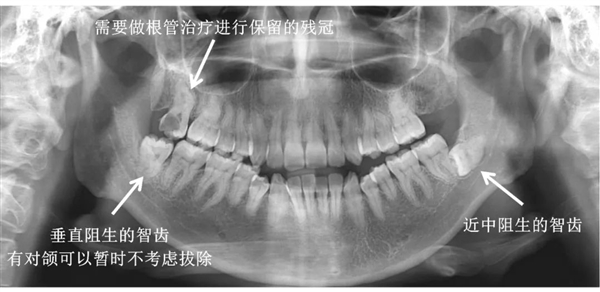 小伙子拔了颗牙 10天后脑出血死亡！