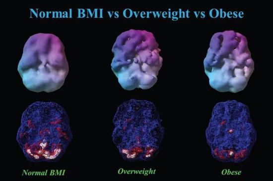 体重对大脑的影响十分惊人：肥胖使大脑萎缩