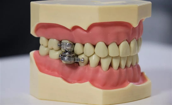 国外开发出新减肥神器：锁住牙齿无法进食
