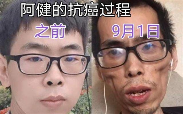 抗癌小伙阿健去世：曾被质疑骗取打赏、生前瘦到皮包骨头