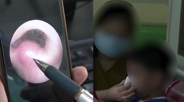 8岁男童挖鼻孔出血致颅内感染 医生：挖鼻孔这个动作要杜绝